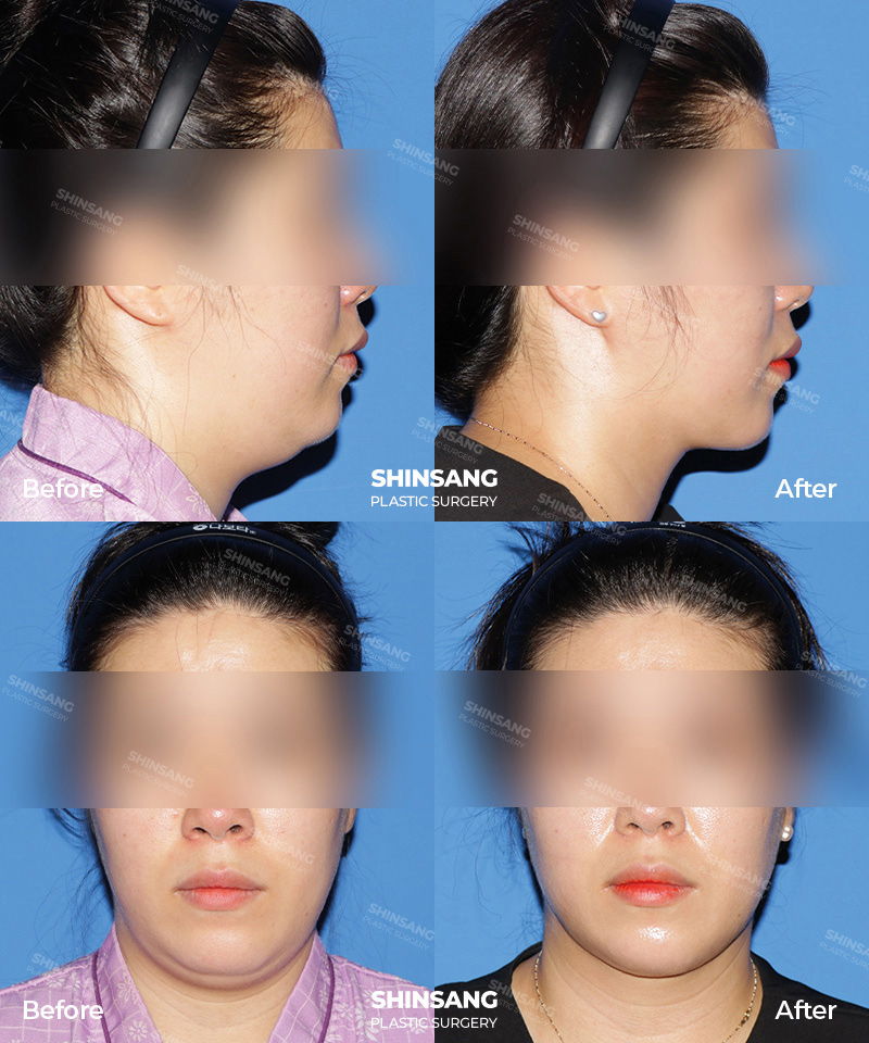 Neck Contouring With Platysma Tightening Patient Review At Sinsang Plastic Surgery In Korea