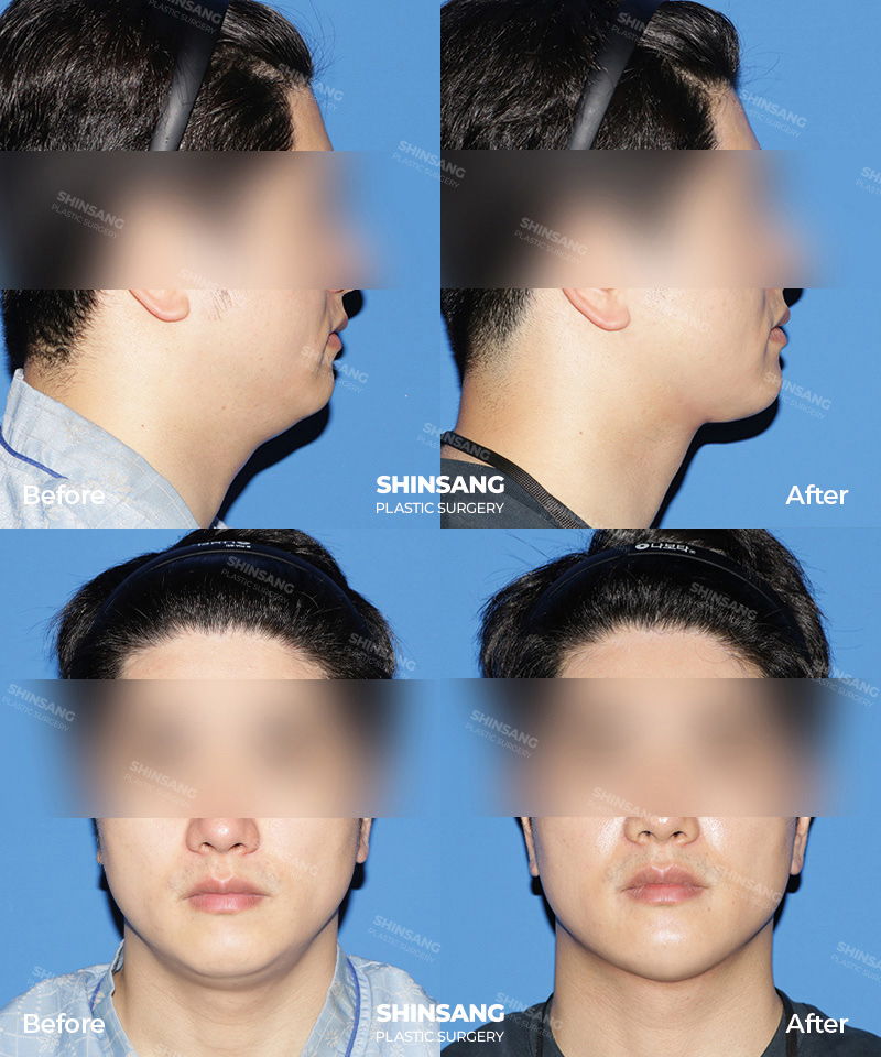 Toad Neck Surgery Neck Contouring Before And After Result At Sinsang Plastic Surgery In Korea