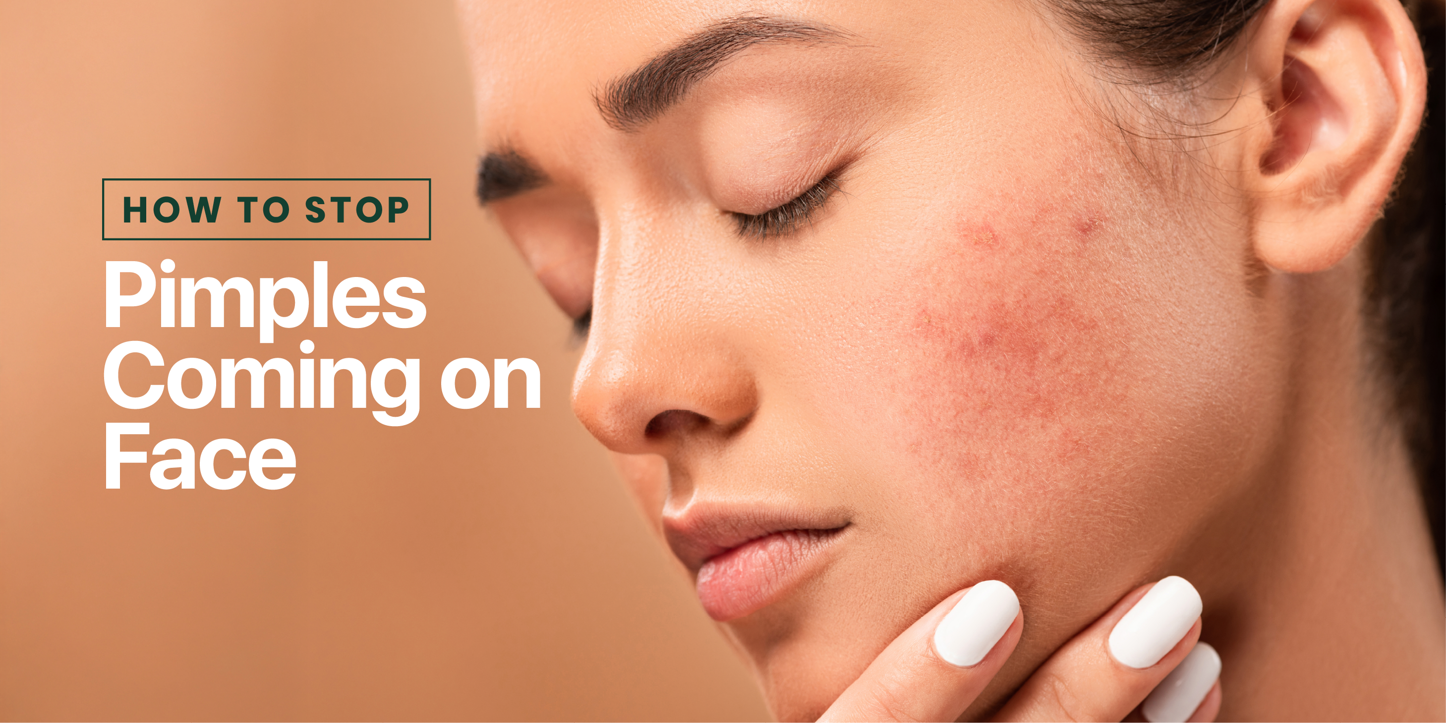 How to Stop Pimples Coming on Face: Simple Tips for Clear and Healthy Skin 