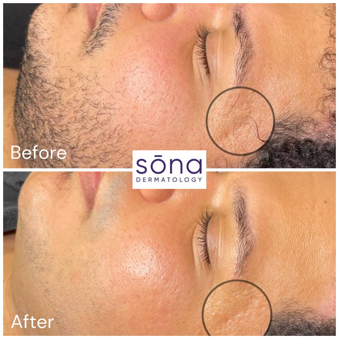 Sona SkinPen Before & After 4