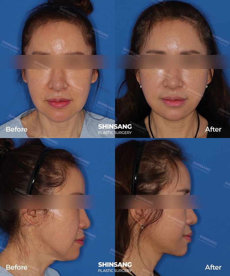 Full Facelift Result Review At Sinsang Plastic Surgery In Korea