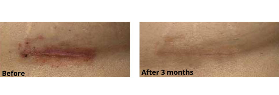 Breast Scar Before and After Using Skinuva Scar for 3 Months
