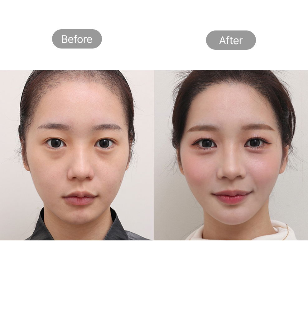 Baby face fat grafting before and after results for youthful facial contour in Korea