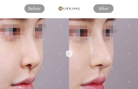 Closed Rhinoplasty Korea Before and After One Month for Nose Bridge and Tip Enhancement