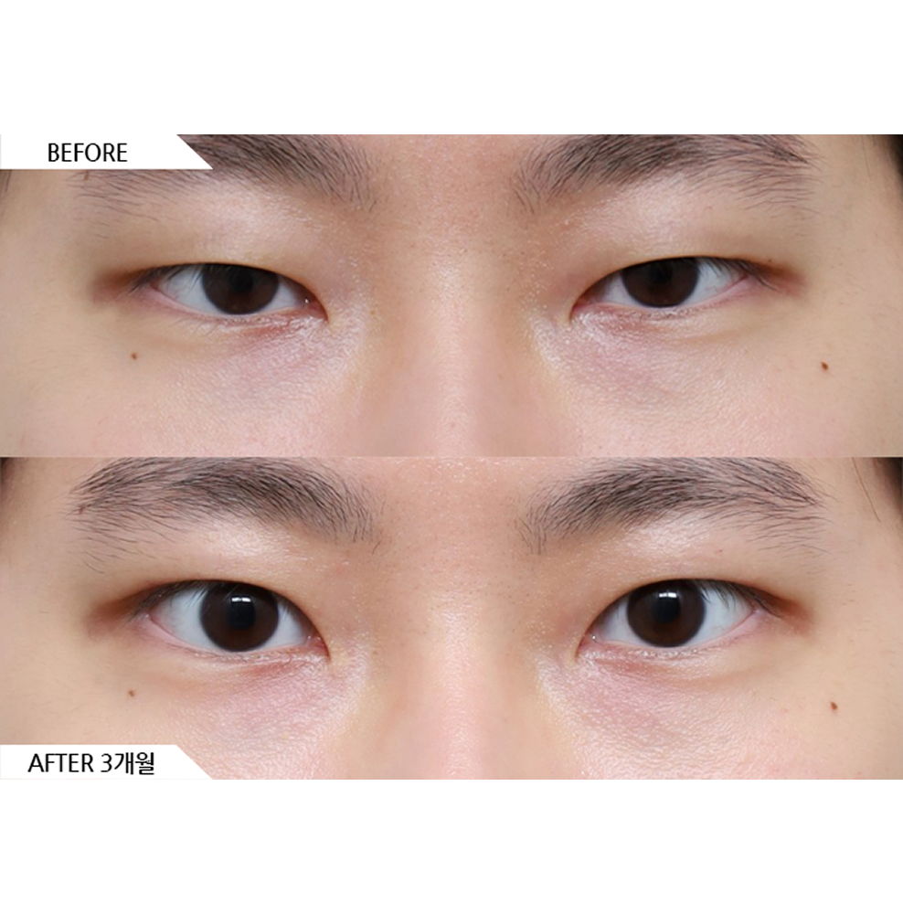 Before and after male eye shape surgery with eye opening procedures showing a more defined yet natural-looking eye shape 3 months after surgery in Korea
