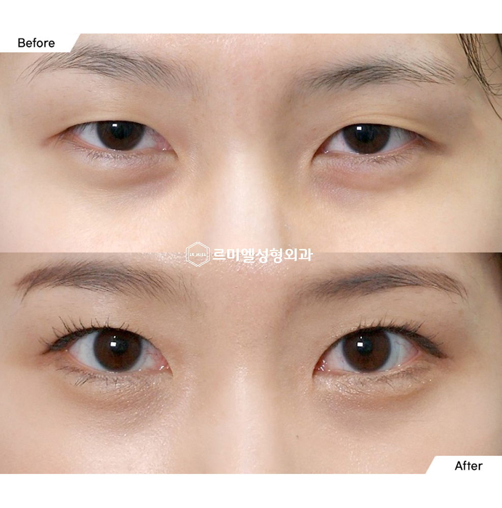 Before and After Results of Non Incisional Ptosis Correction and Upper Eyelid Surgery