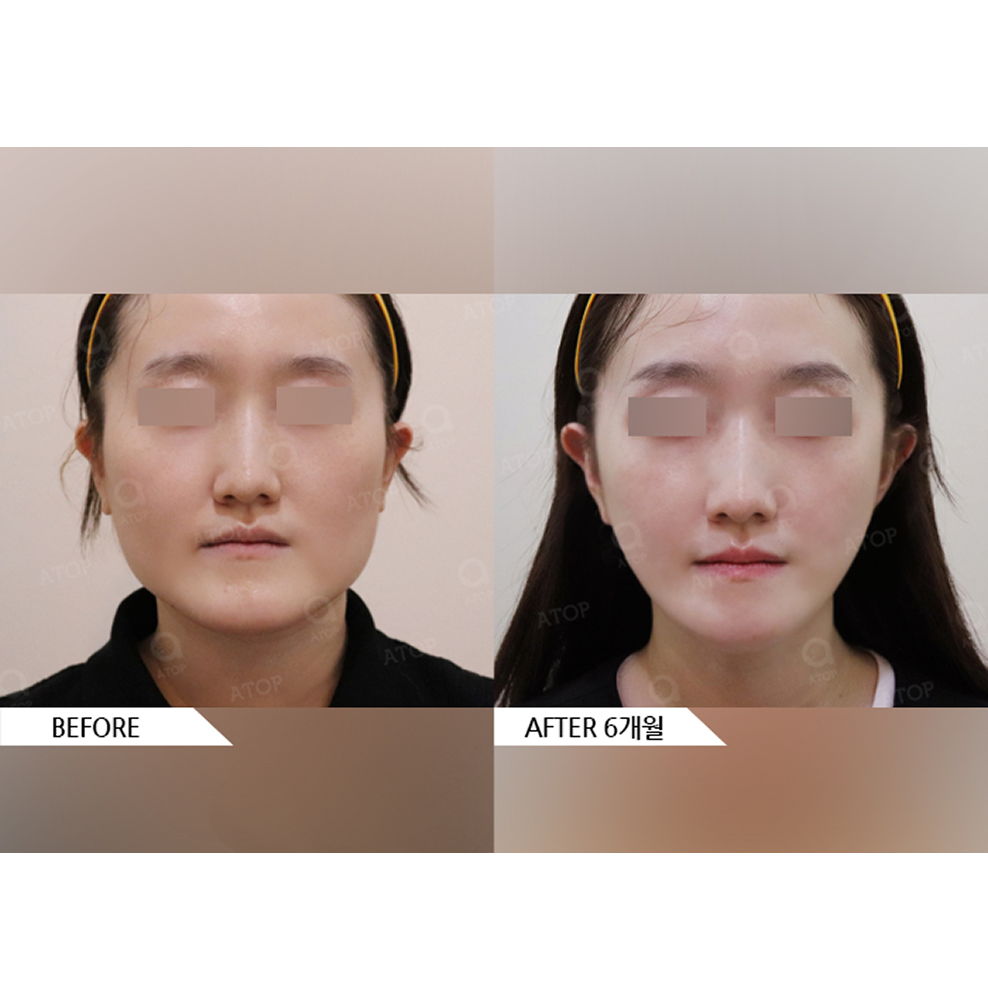 Before and after results of facial contouring surgery including jaw reduction, cheekbone reduction, and chin surgery for a slimmer V-line face in Korea