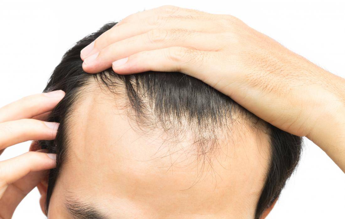 Is Minoxidil an Effective Treatment for a Receding Hairline? – DS  Healthcare Group