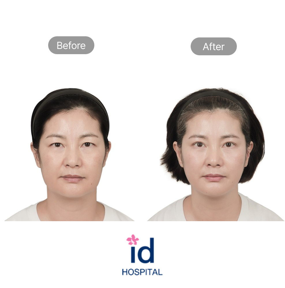 Brow Lift and Lower Blepharoplasty Before and After Result at ID Hospital