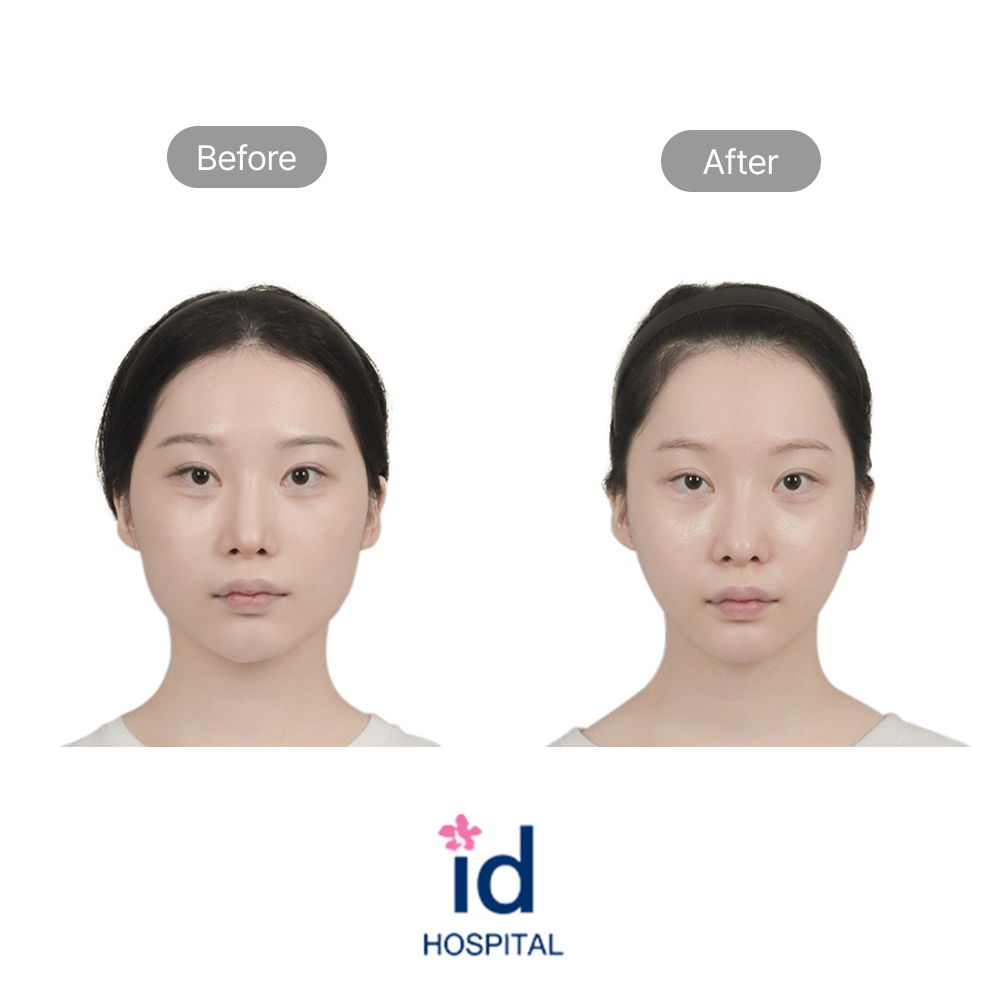 Square Jaw, Chin, and Cheekbone Reduction Before and After Result at ID Hospital