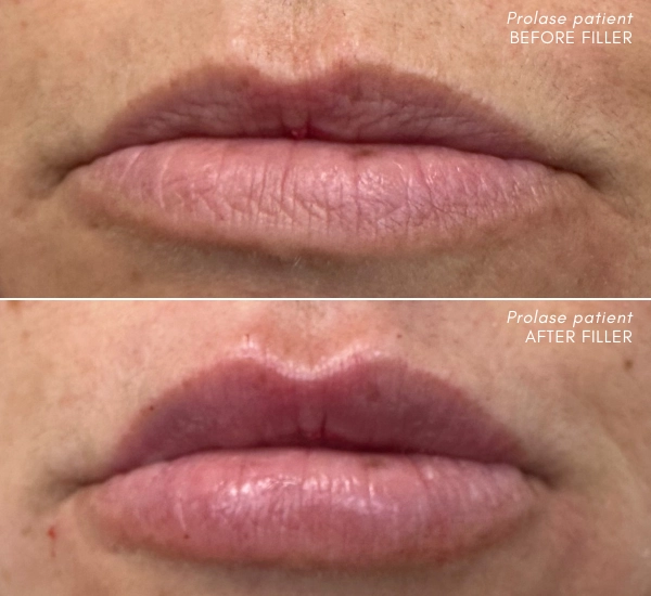 Prolase Patient before and after 1ml of Juvederm Ultra XC by Dr. Karo
