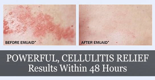 Before and after pictures of cellulitis