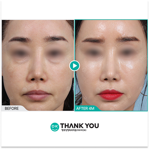 Skin Botox for Korean Summer Skin Treatments Focused on Pore Tightening, Sebum Control, and Glass Skin Results
