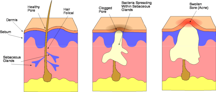 Biologique Recherche acne illustration 