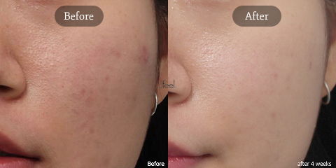 Korean Acne Treatment Seoul for Summer Breakouts, Enlarged Pores, and Post-Acne Marks with Aqua Peeling and Acne Laser Care