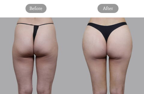 Before And After Result Image Of Buttock And Pelvic Fat Grafting At Girin Plastic Surgery Clinic In Korea