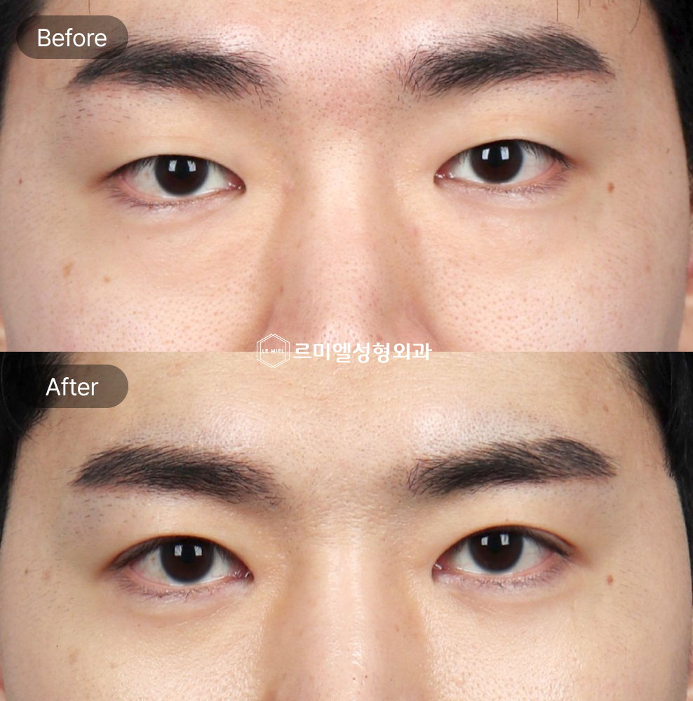 Before and After Results of Male Eye Surgery After Three Months