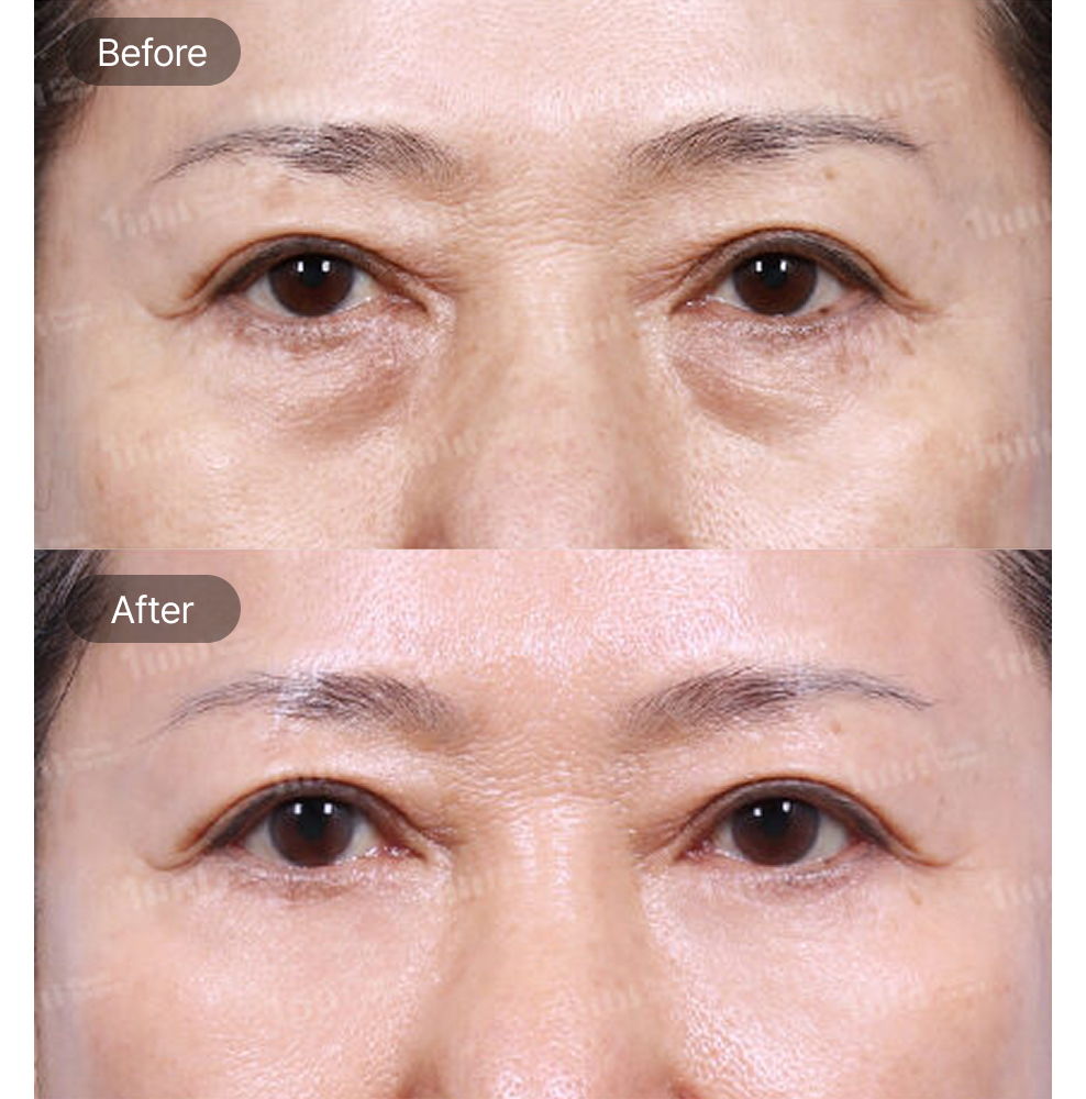 Under Eye Fat Grafting Before and After Results at 1MM Plastic Surgery in Korea for Smoother and More Youthful Under Eyes