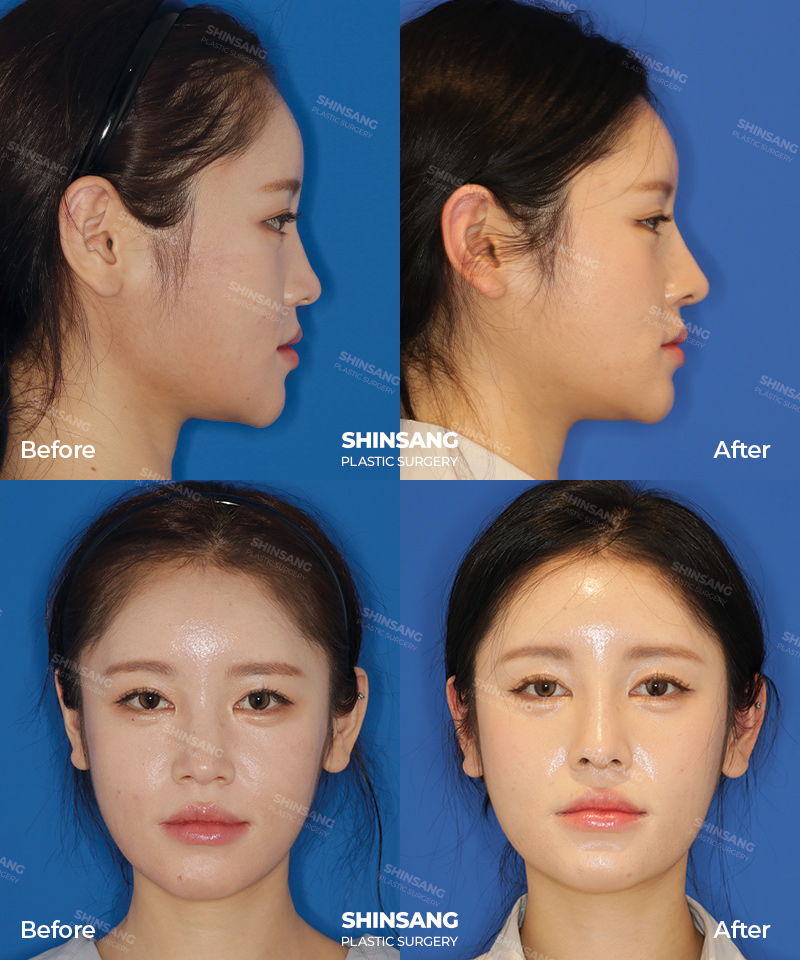 Nose Bridge Augmentation And Nose Tip Surgery Before And After Result At Sinsang Plastic Surgery In Korea