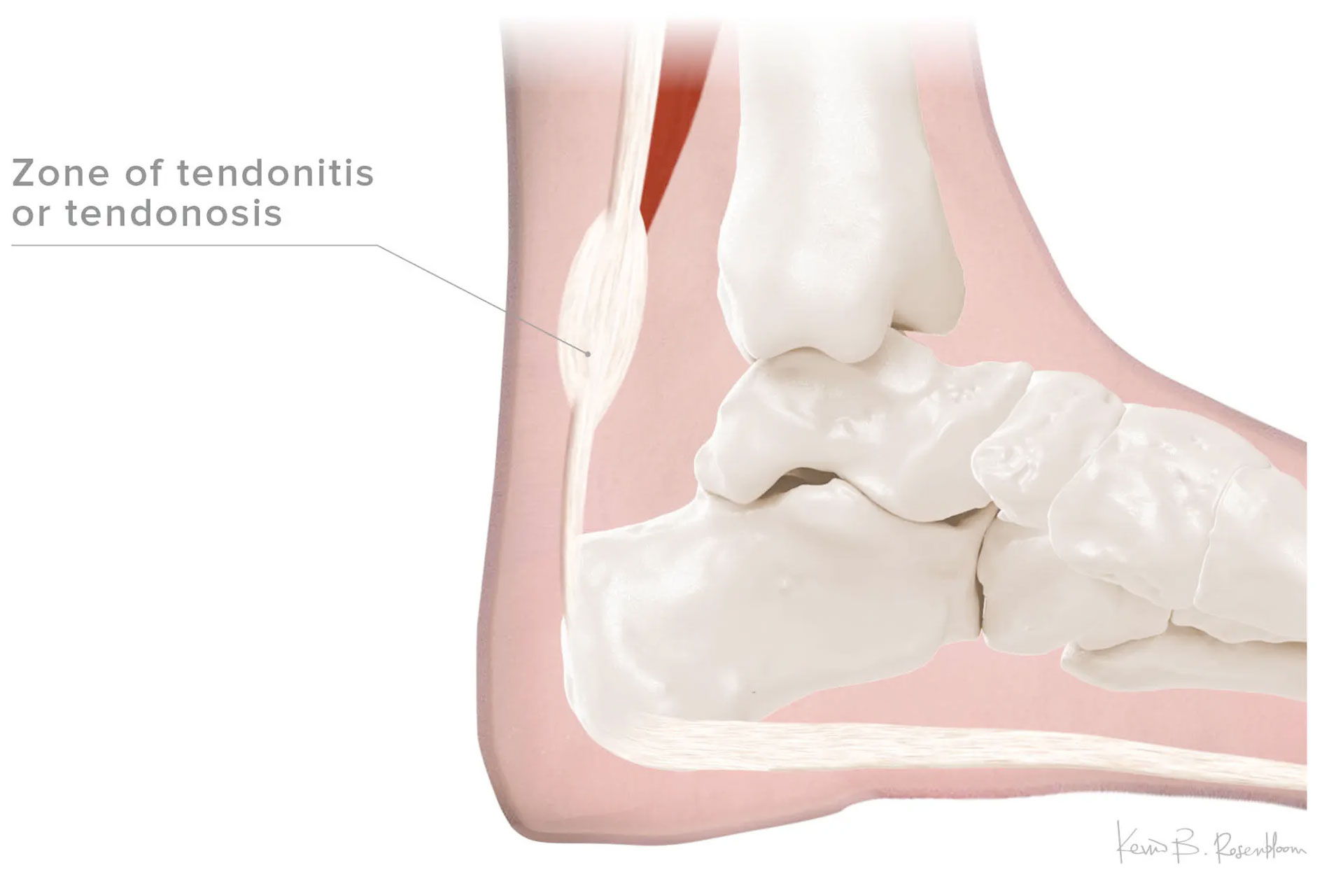 Achilles Tendinitis