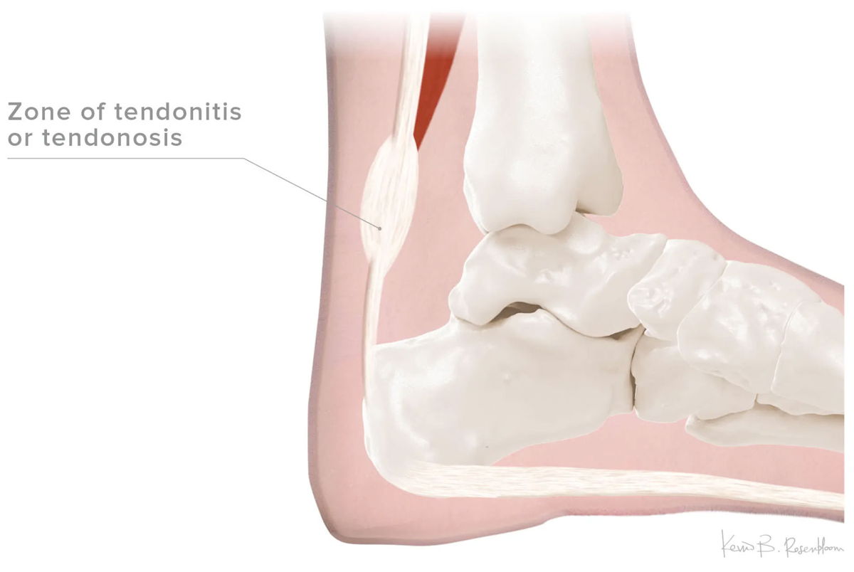 Achilles tendon anatomy — lateral view of foot and ankle