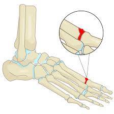 where does turf toe occur