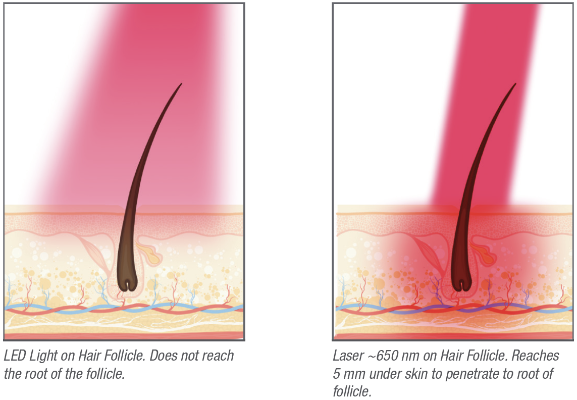 Capillus | How Does Hair Loss Occur?