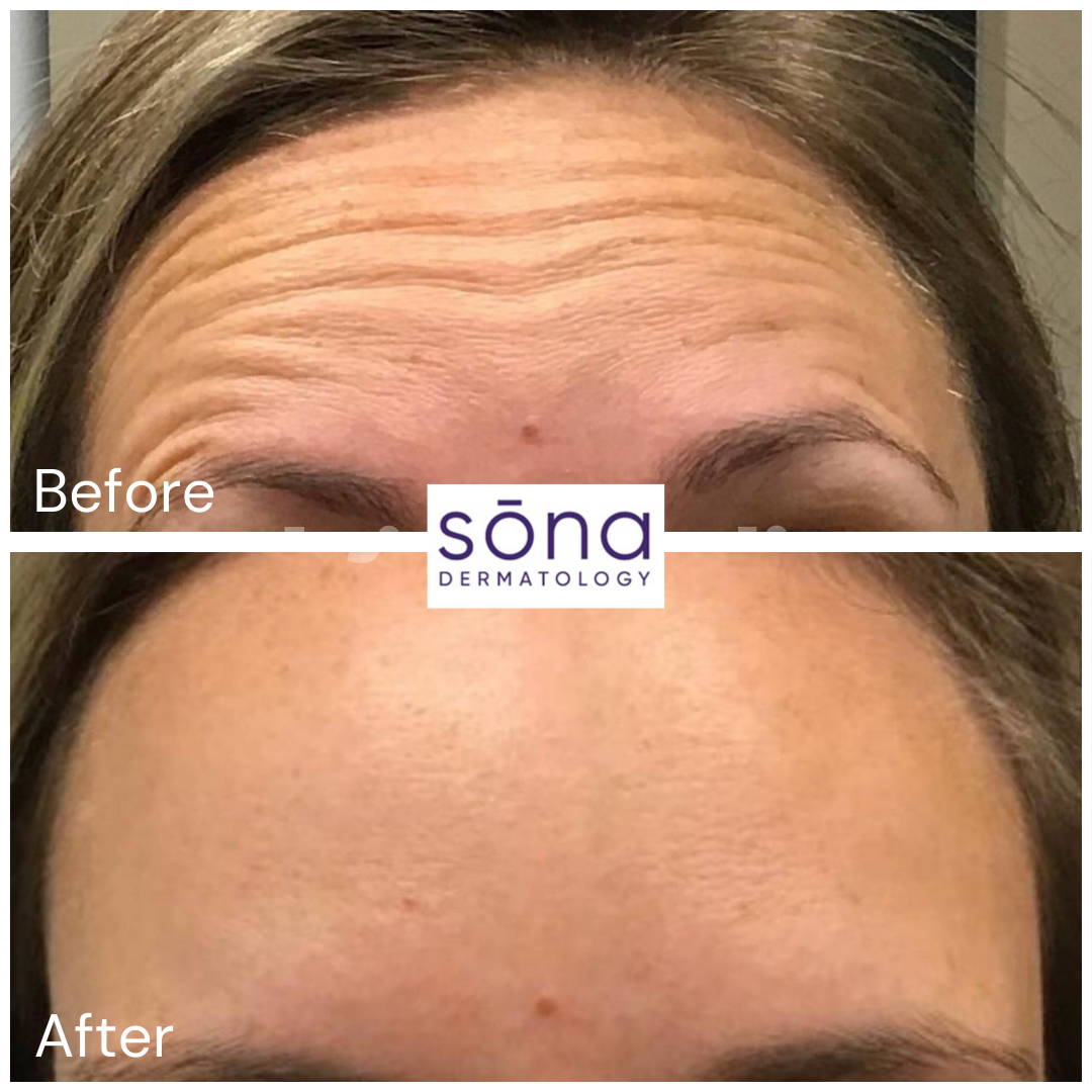 Sona - Botox Cosmetic Before & After 17