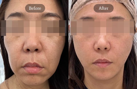 Mid and lower face lifting results for sagging skin using thread lift and fat transfer, improving jawline definition and facial firmness