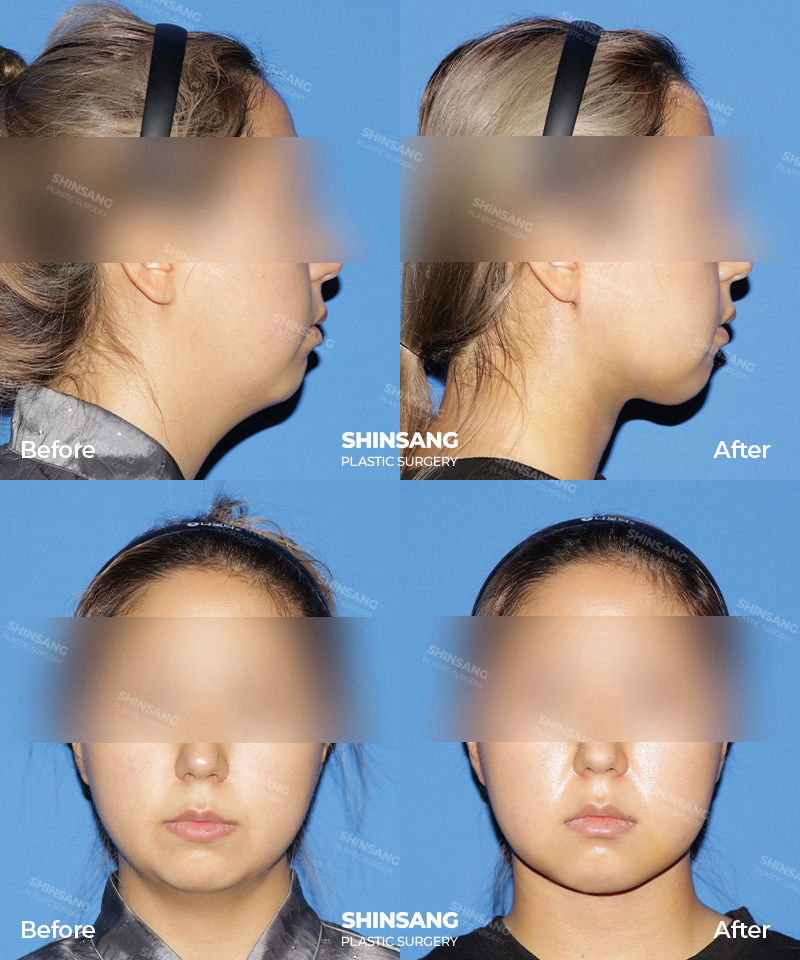 Toad Neck Surgery Neck Reduction Patient Review At Sinsang Plastic Surgery In Korea