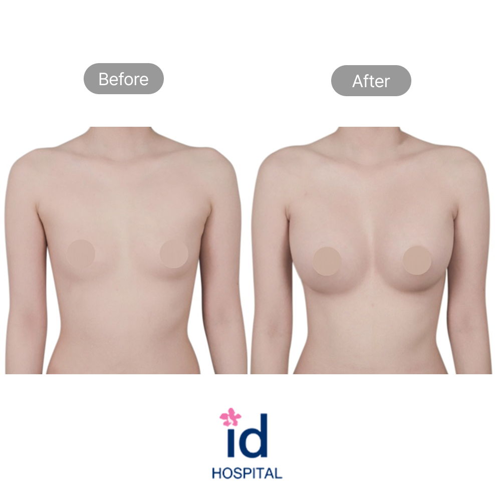 Breast Enhancement Surgery Before and After Result at ID Hospital