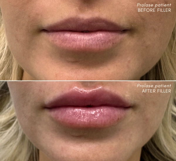 Prolase Patient before and after 1ml of Juvederm Ultra XC with Enesae Keshishian RN