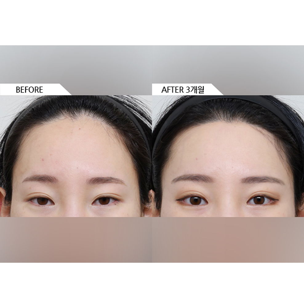 Before and after results of forehead reduction and forehead lift surgery showing a lowered hairline and lifted brows with improved facial proportions 3 months after surgery in Korea