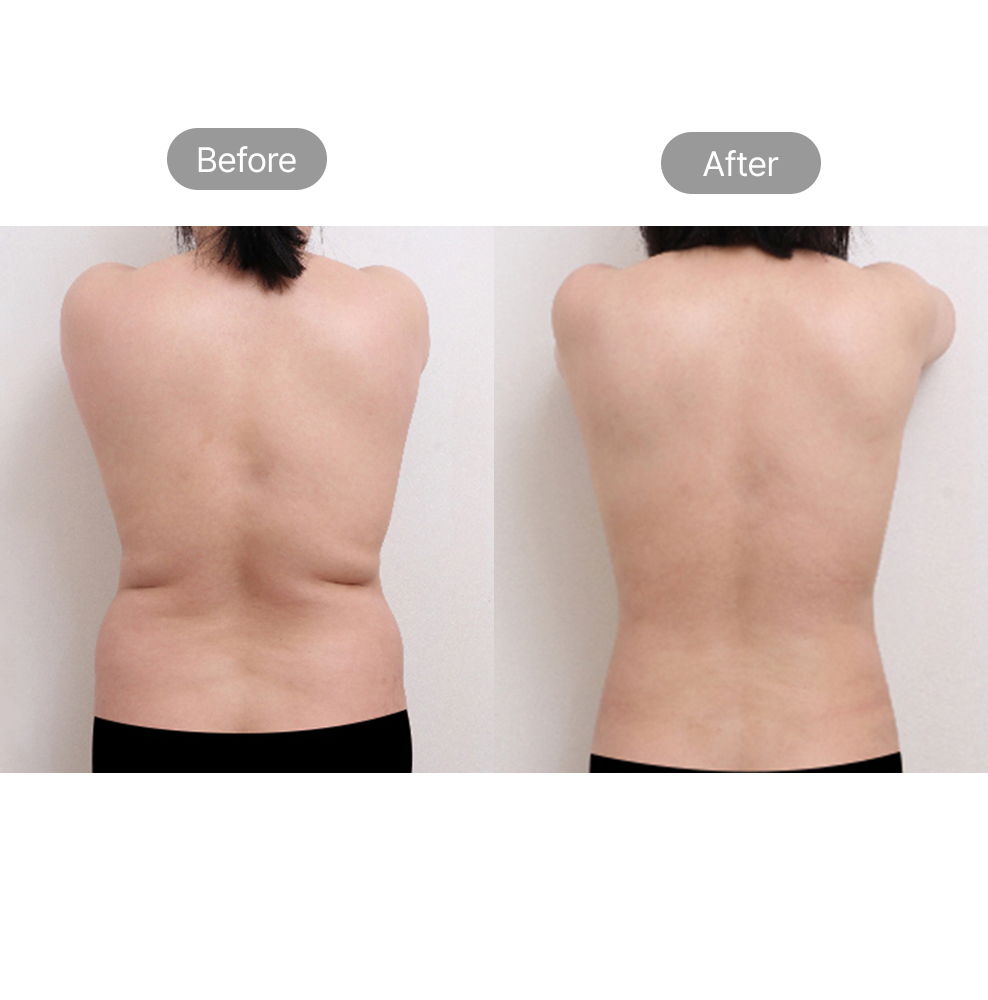 Back liposuction before and after results for upper body contouring in Korea