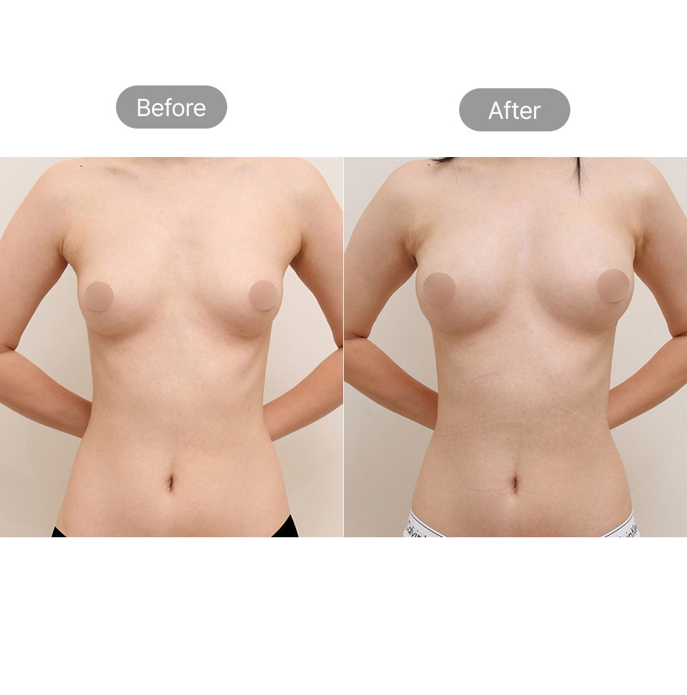 Breast fat grafting and body line improvement before and after results in Korea