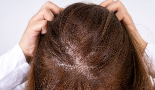 Is Hair Loss From Diabetes Type 2 Permanent? – DS Healthcare Group