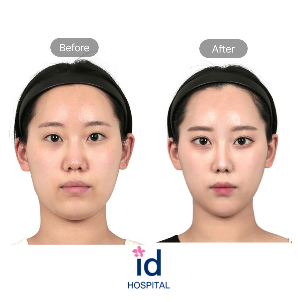 Double Eyelid Buried Suture, Eye Reshaping, Direct Line Rhinoplasty, and Facial Contouring Before and After Result at ID Hospital