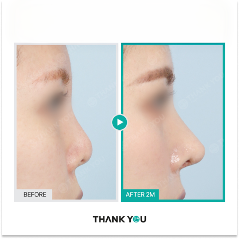 Revision rhinoplasty for short nose at 2 months post op showing early healing stage and gradual nasal lengthening in Korea