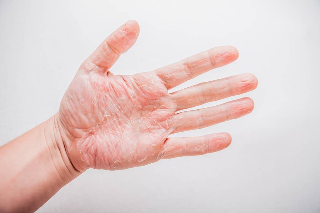 Dies ist ein Bild von einer Hand mit trockener Haut.