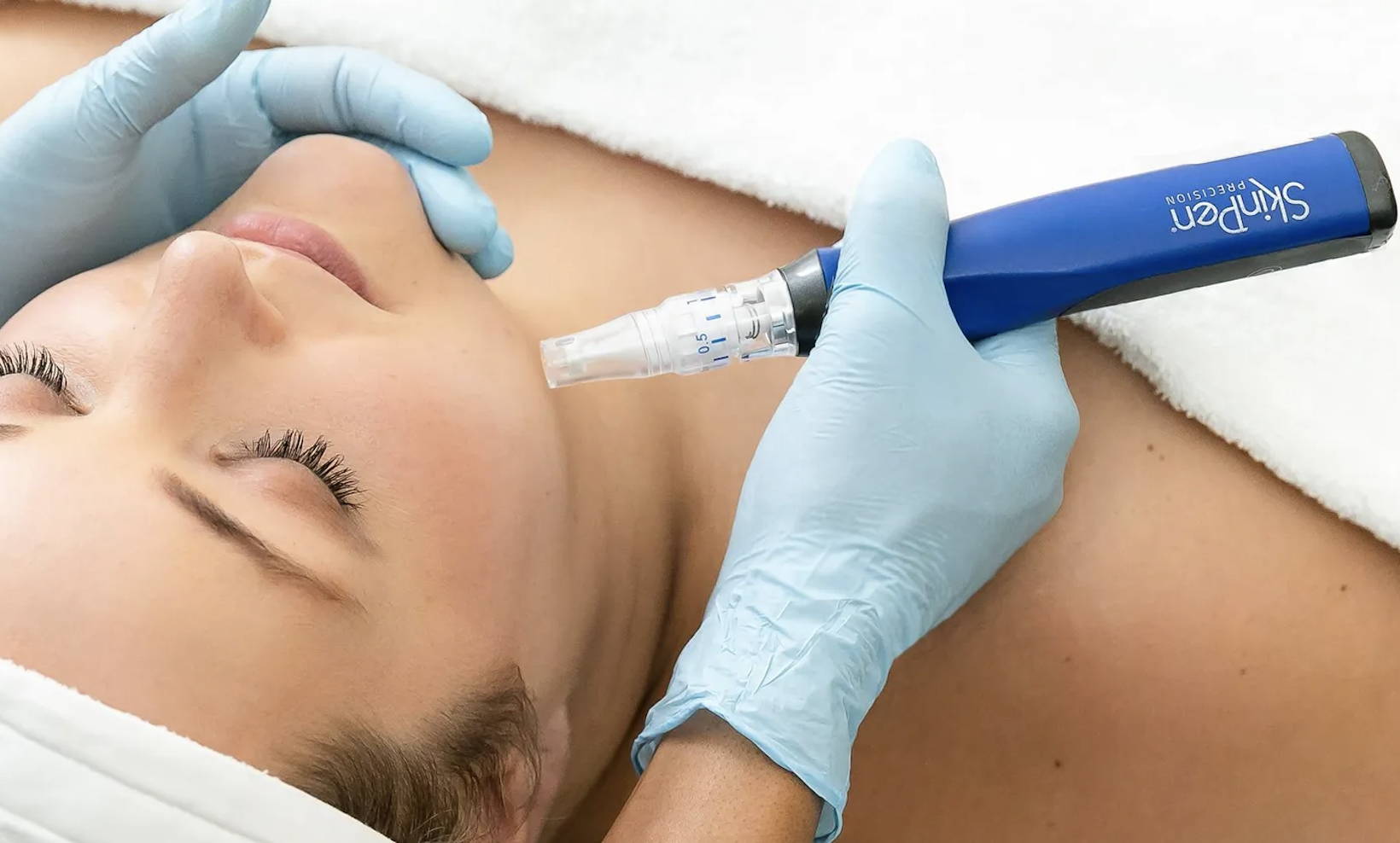 Sona SkinPen Microneedling Treatment