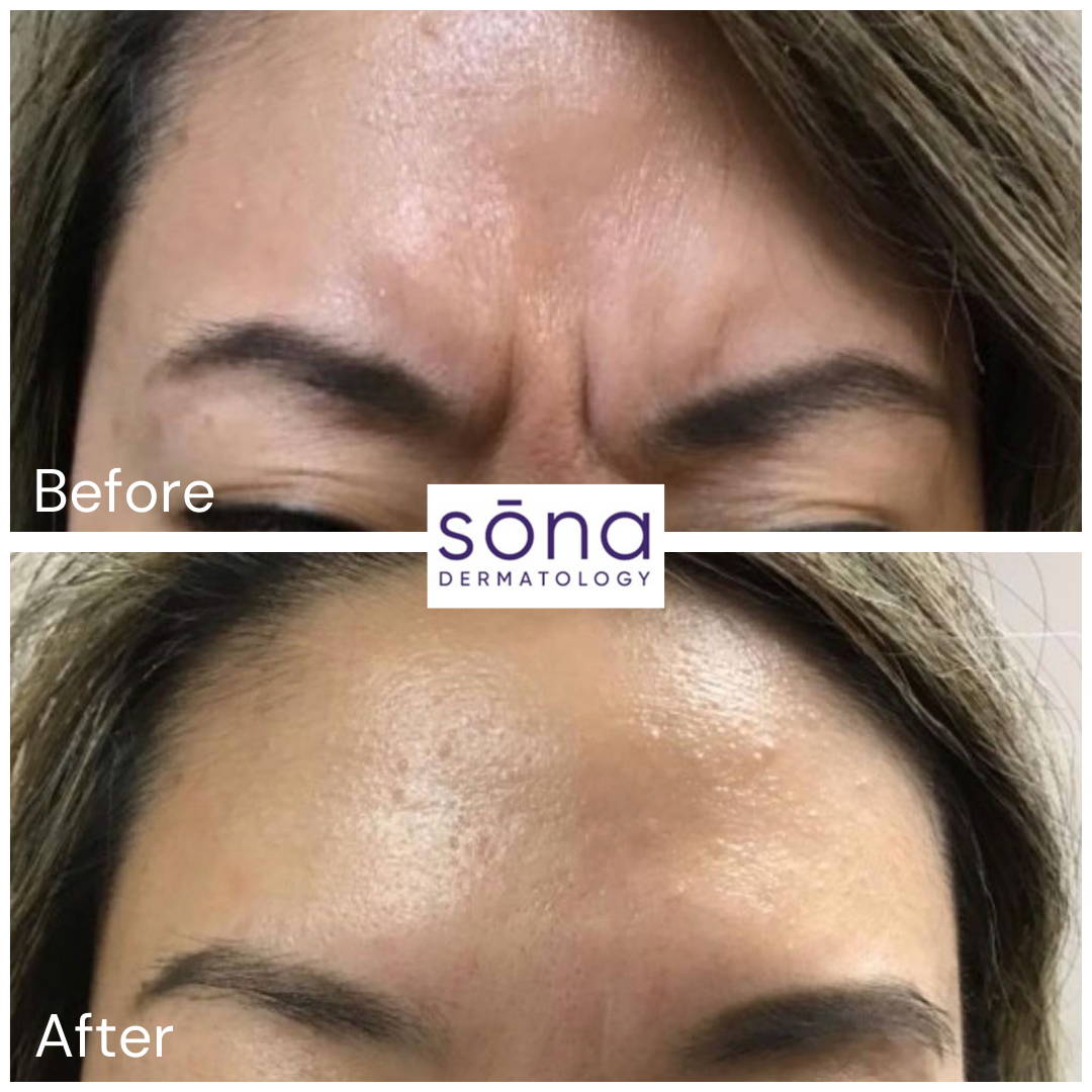 Sona - Botox Cosmetic Before & After 6