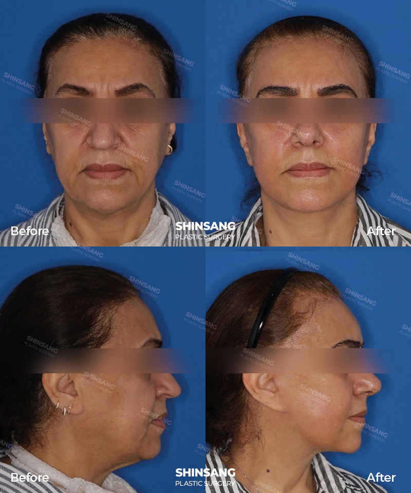 Full Facelift Forehead Lift And Full Face Fat Grafting Result At Sinsang Plastic Surgery In Korea
