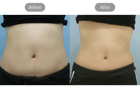Before And After Review Image Of Diet Injection Treatment At Jfeel Clinic In South Korea