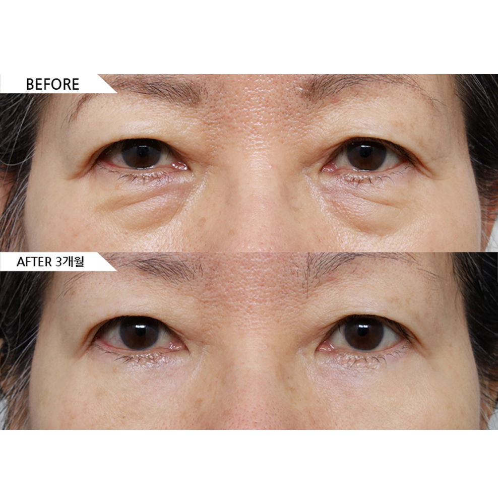 Before and after results of lower eyelid surgery and canthoplasty showing reduced under eye bags and a more youthful eye appearance in Korea