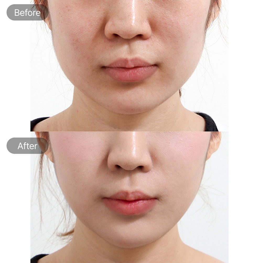 Nasolabial fold correction before and after results at Fresh Dr. Hong Plastic Surgery in Korea
