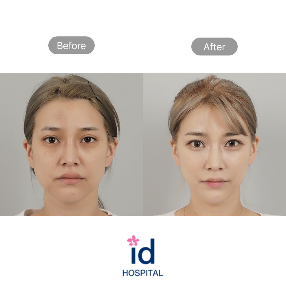 Mini Facelift Before and After Result at ID Hospital