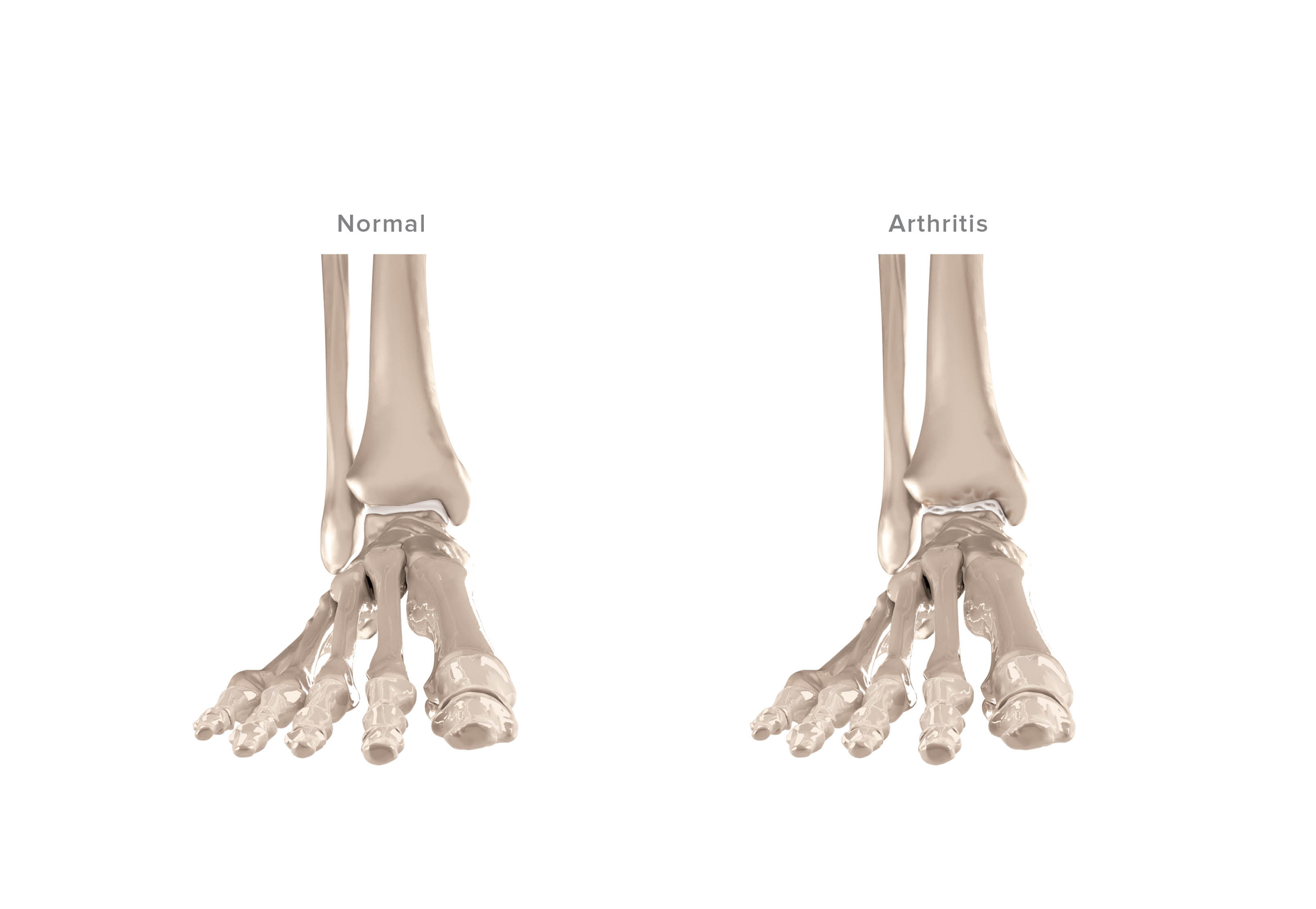 Ankle & Foot Arthritis