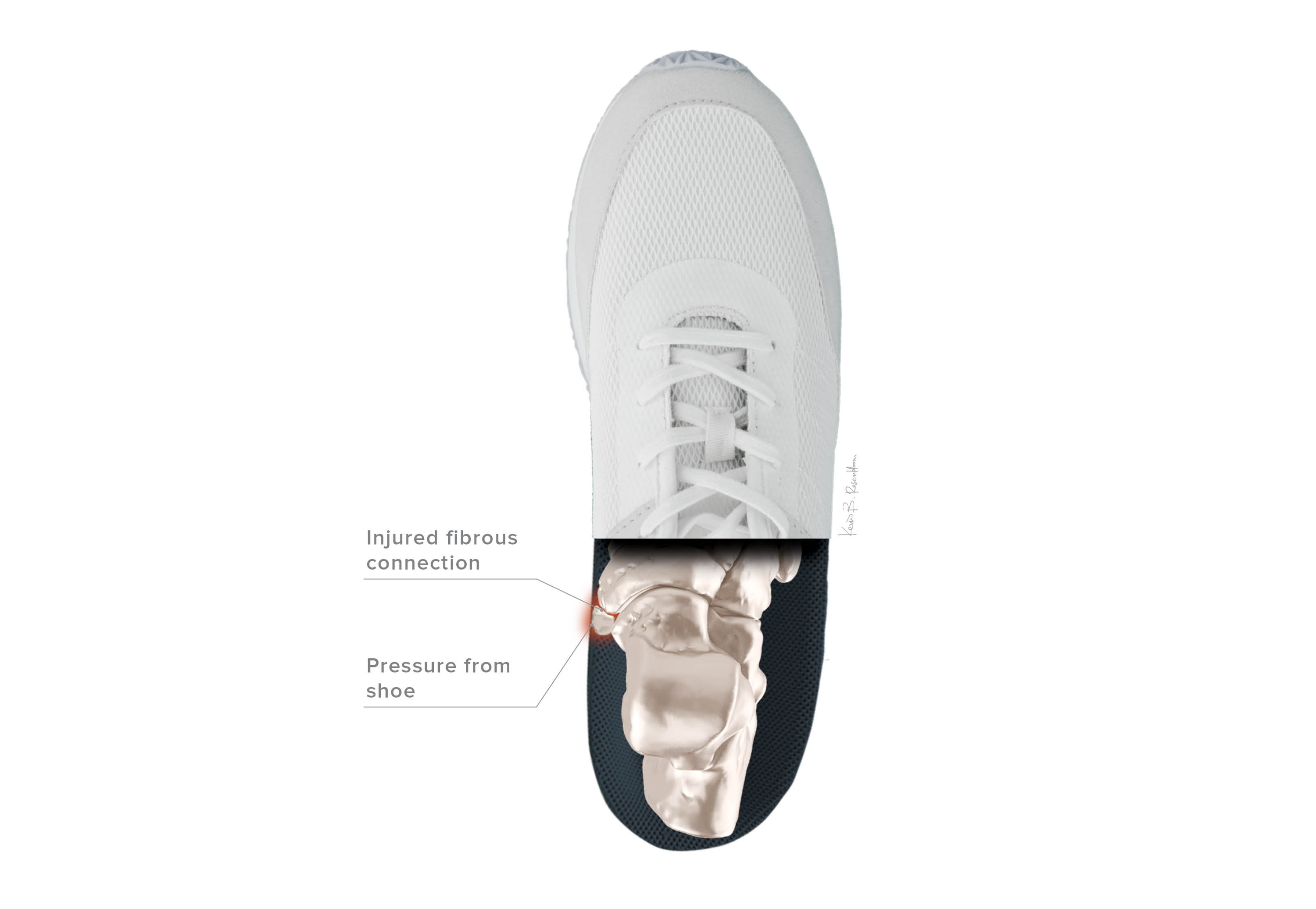 Accessory Navicular Syndrome