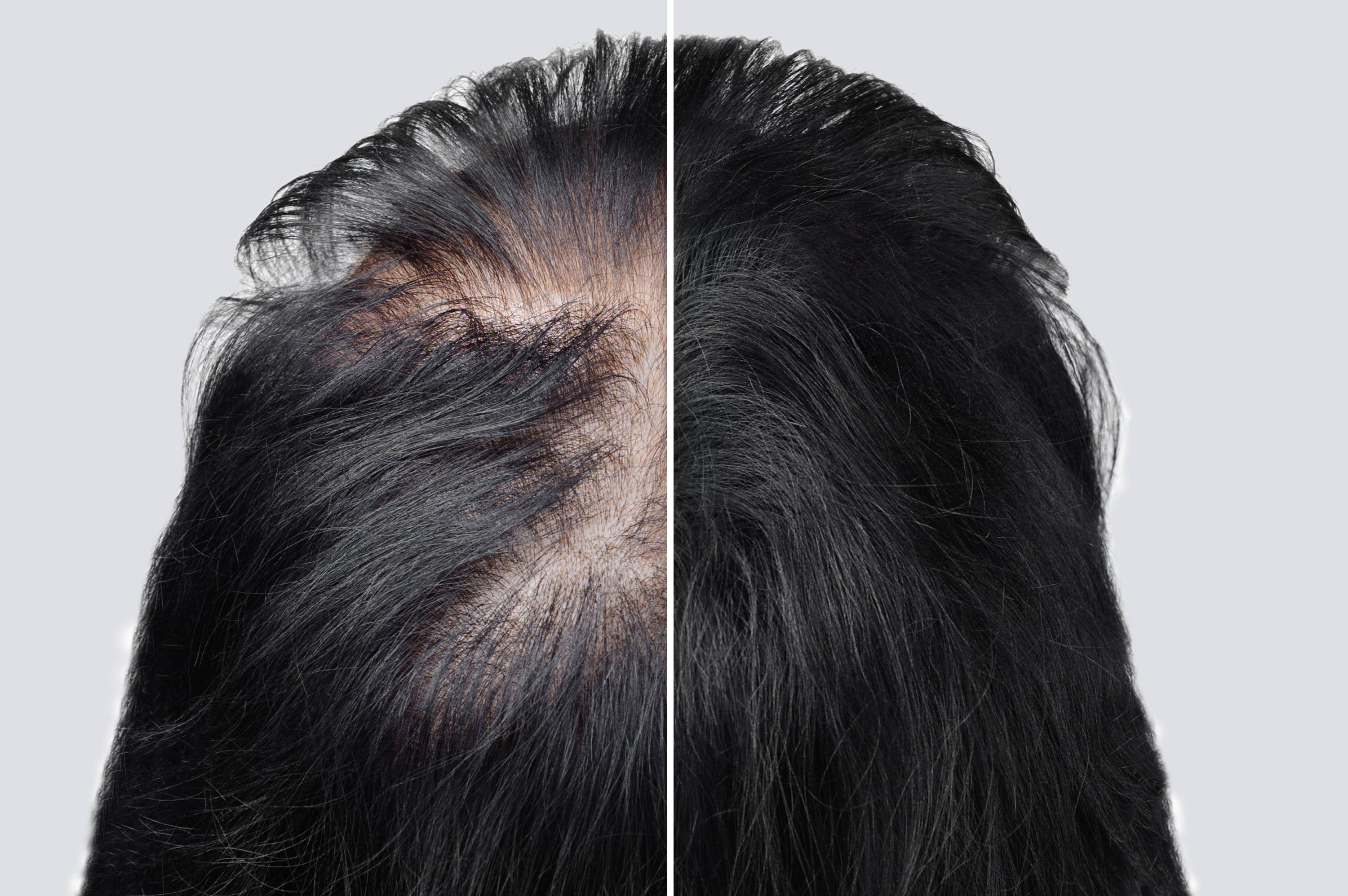Understanding the Different Types of Hair Loss – DS Healthcare Group