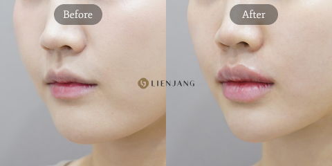 Lip filler before and after results in Korea showing natural volume enhancement and improved lip definition